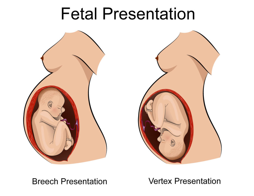 how-to-deliver-a-baby-in-breech-position-faculty-of-medicine