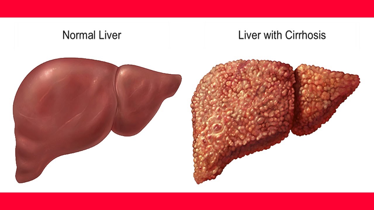 Review Article The Reversibility Of Cirrhosis Faculty Of Medicine