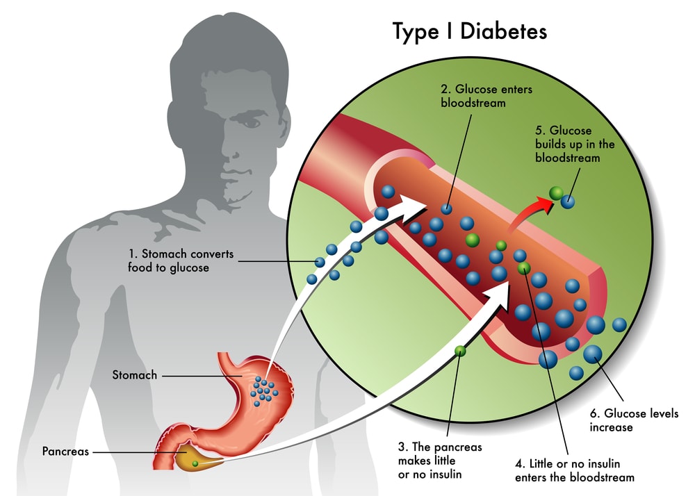 hypothesis type 1 diabetes