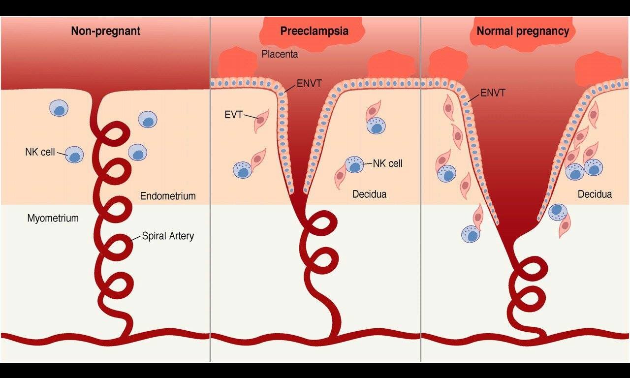 What Is Preeclampsia