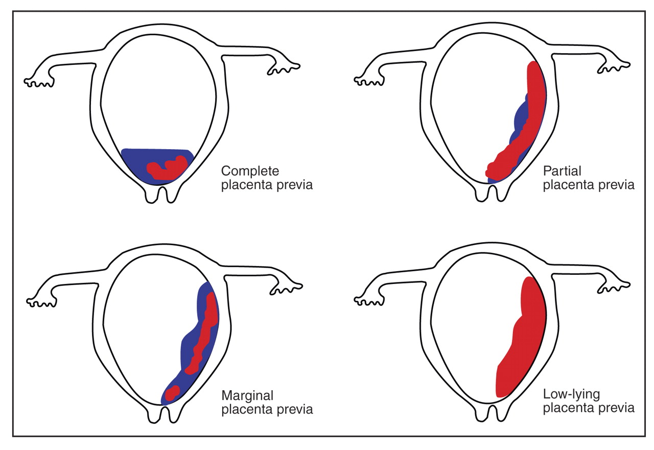 Placenta Previa - Causes, Types And Management | Faculty ...