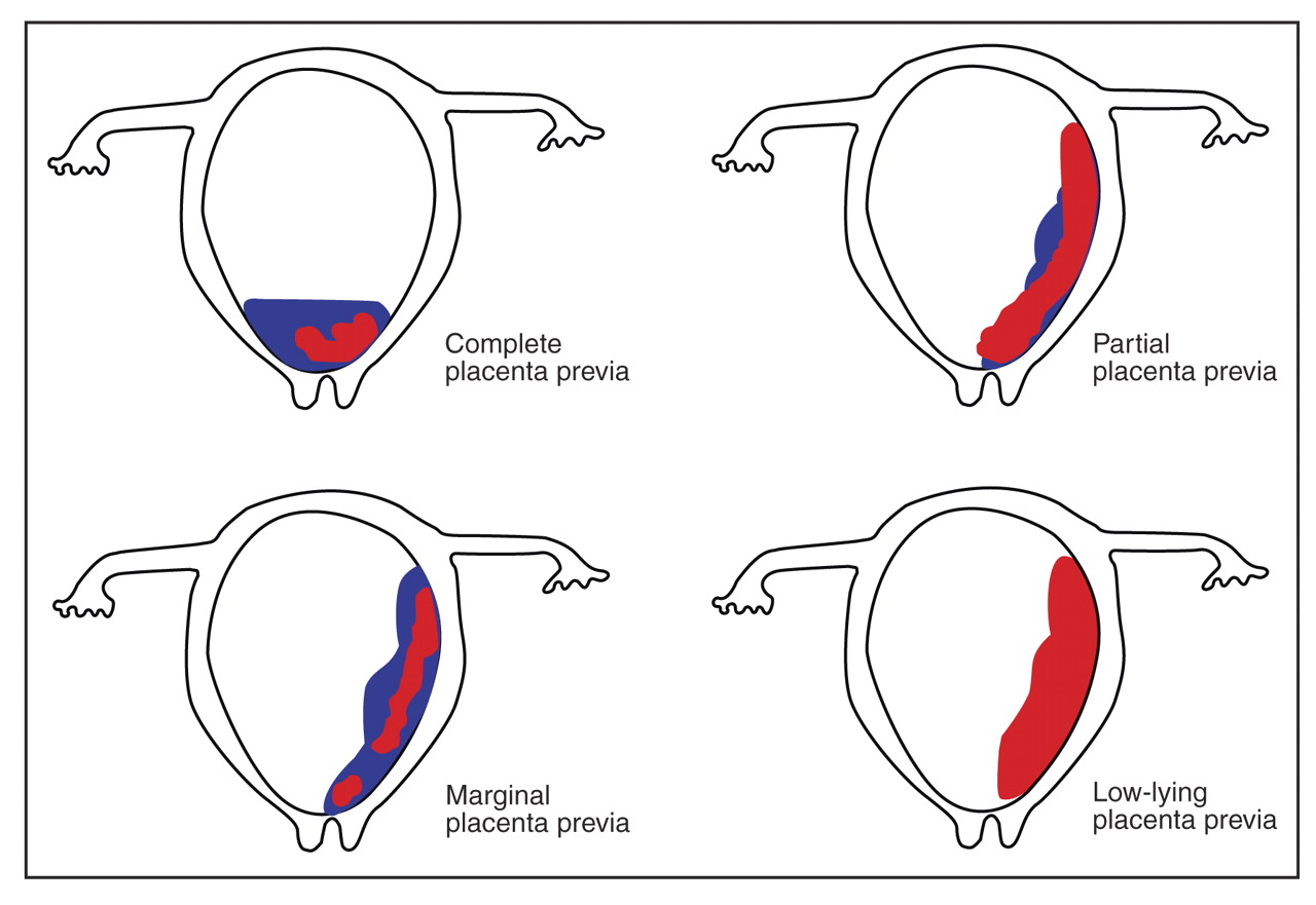 Placenta Previa Causes Types And Management Faculty Of Medicine