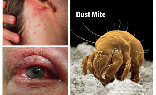 Skin Irritations And Watery Eyes Dust Mites Are Probably The Problem   812f2ccd41de2a33380dacec48fd7117 Jpg.13161