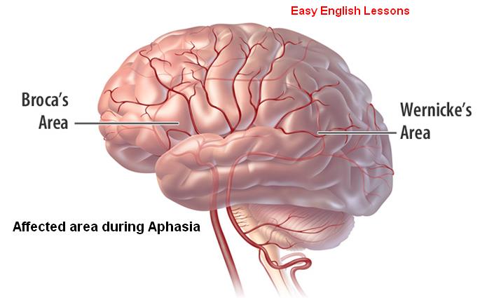 Aphasia : A Language Disorder after a Stroke | Faculty of Medicine