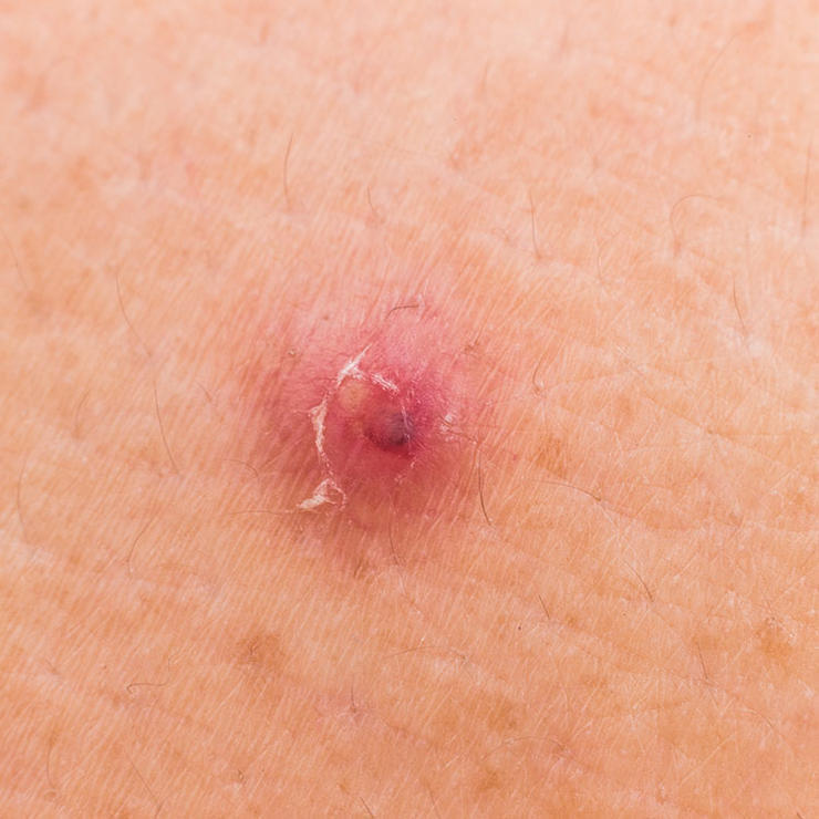 7 Types Of Bumps And Blemishes You Should Never Try To Pop Faculty
