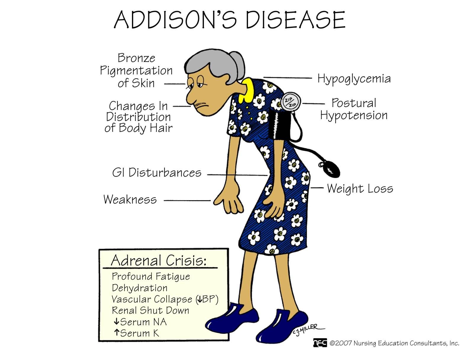 Understanding Addisons Disease Faculty Of Medicine 6071