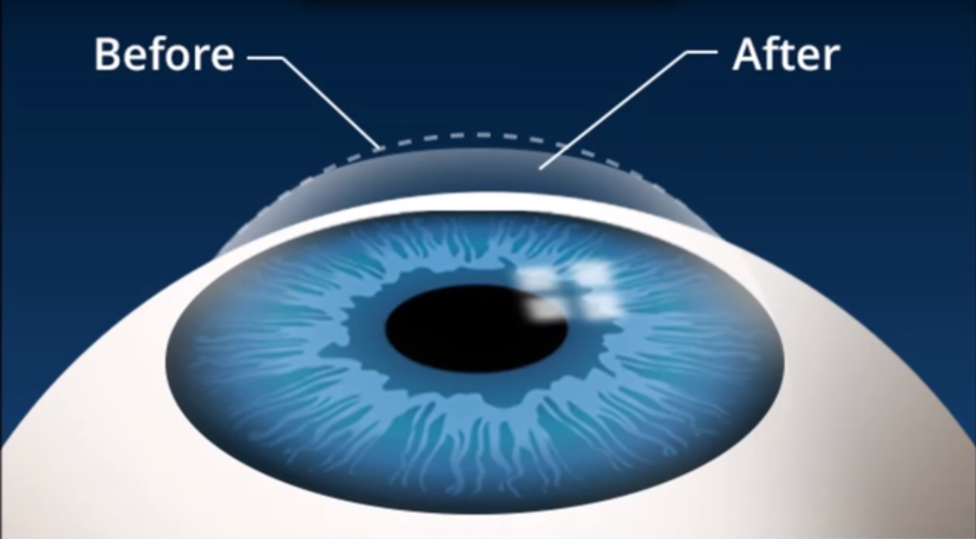 Зрение 2 операция. Фемто ласик. Лазерная коррекция зрения. Рефракционная коррекция зрения. Лазерная операция на глаза.