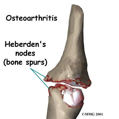 finger_mucouscyst_anatomy02.jpg