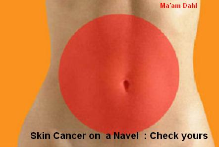 Skin cancer on navel.JPG