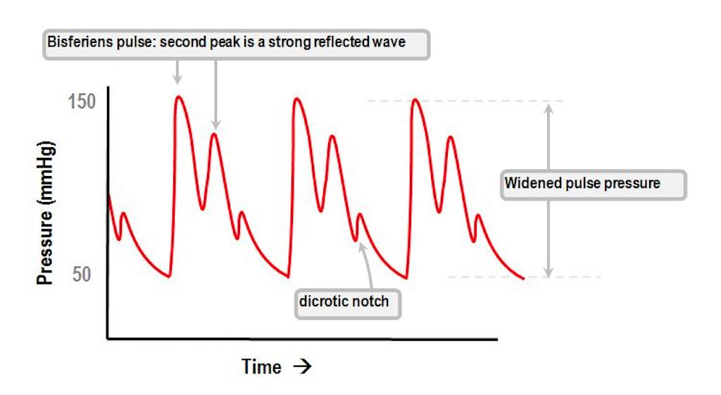 Widened/Wide Pulse Pressure: Definition, Causes ...