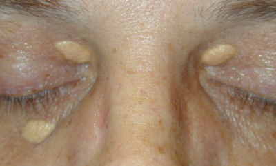 Xanthelasma.jpg