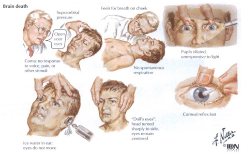 Signs Of Brain Death Faculty Of Medicine