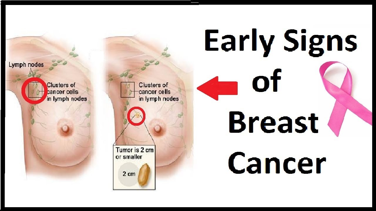 Woodlands Limited - Early warning signs of breast cancer include