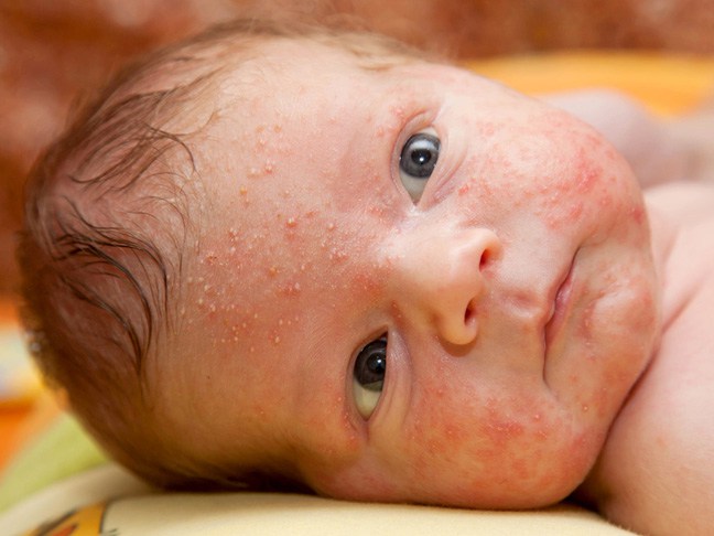 Deadly Kiss: Can a Baby Contract a Lethal Virus from a Cold Sore ...