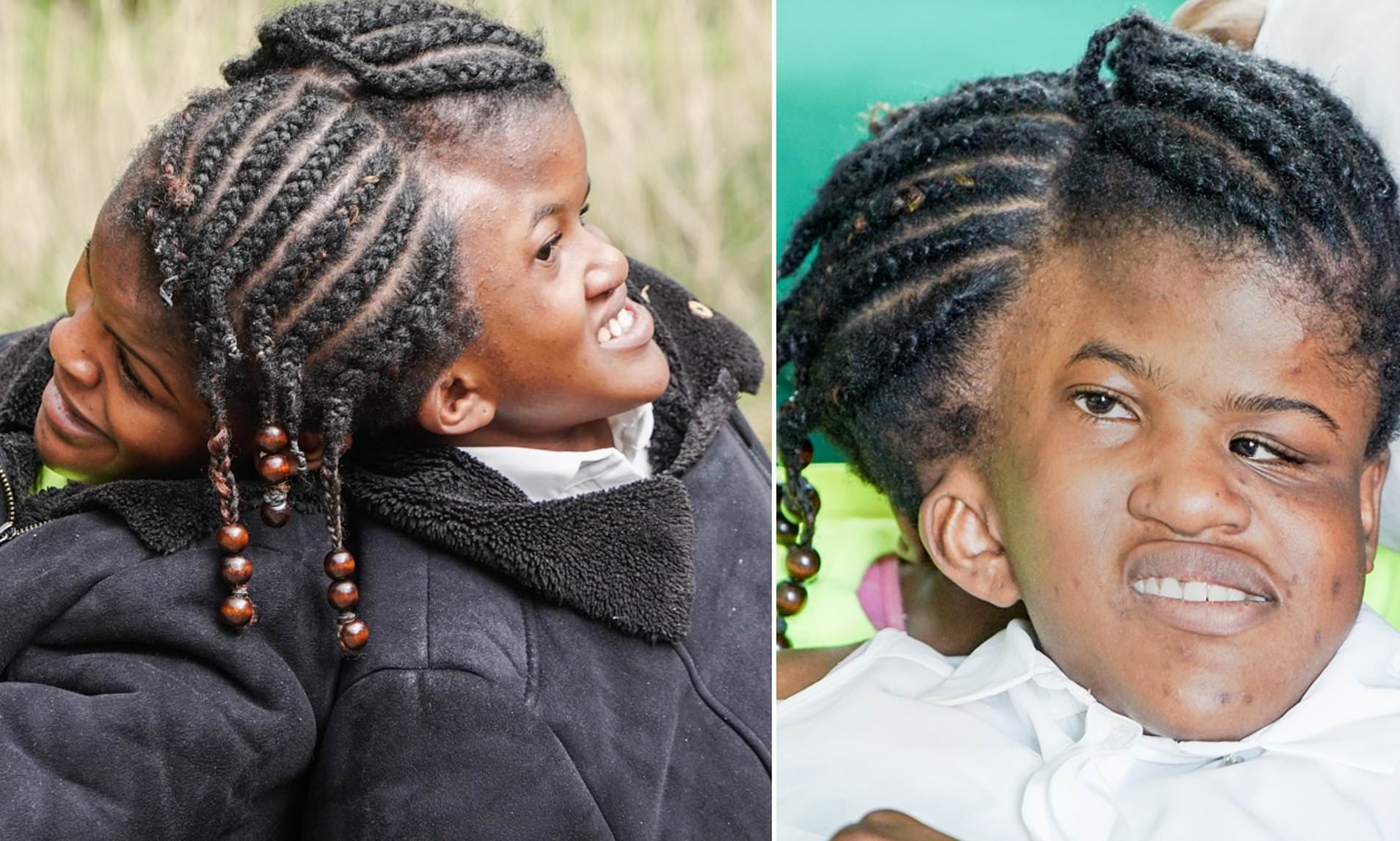 Conjoined Twin Sisters Who Can Never Be Separated Defy Doctors Who Said They Wo Erofound