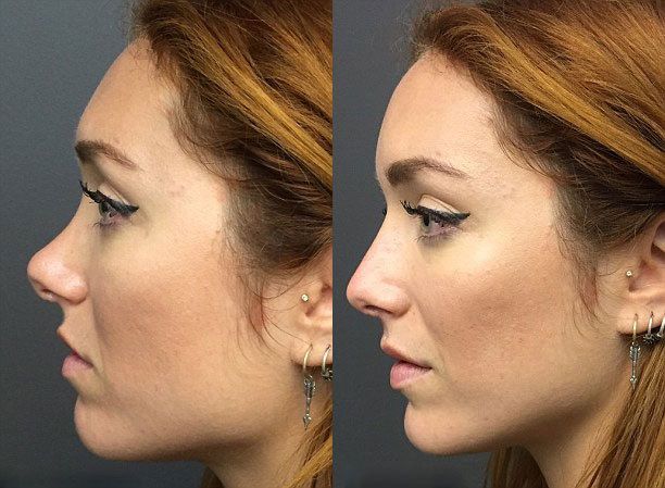 The Nonsurgical Nose Job May Be Too Good to Be True!!! | Faculty of Medicine