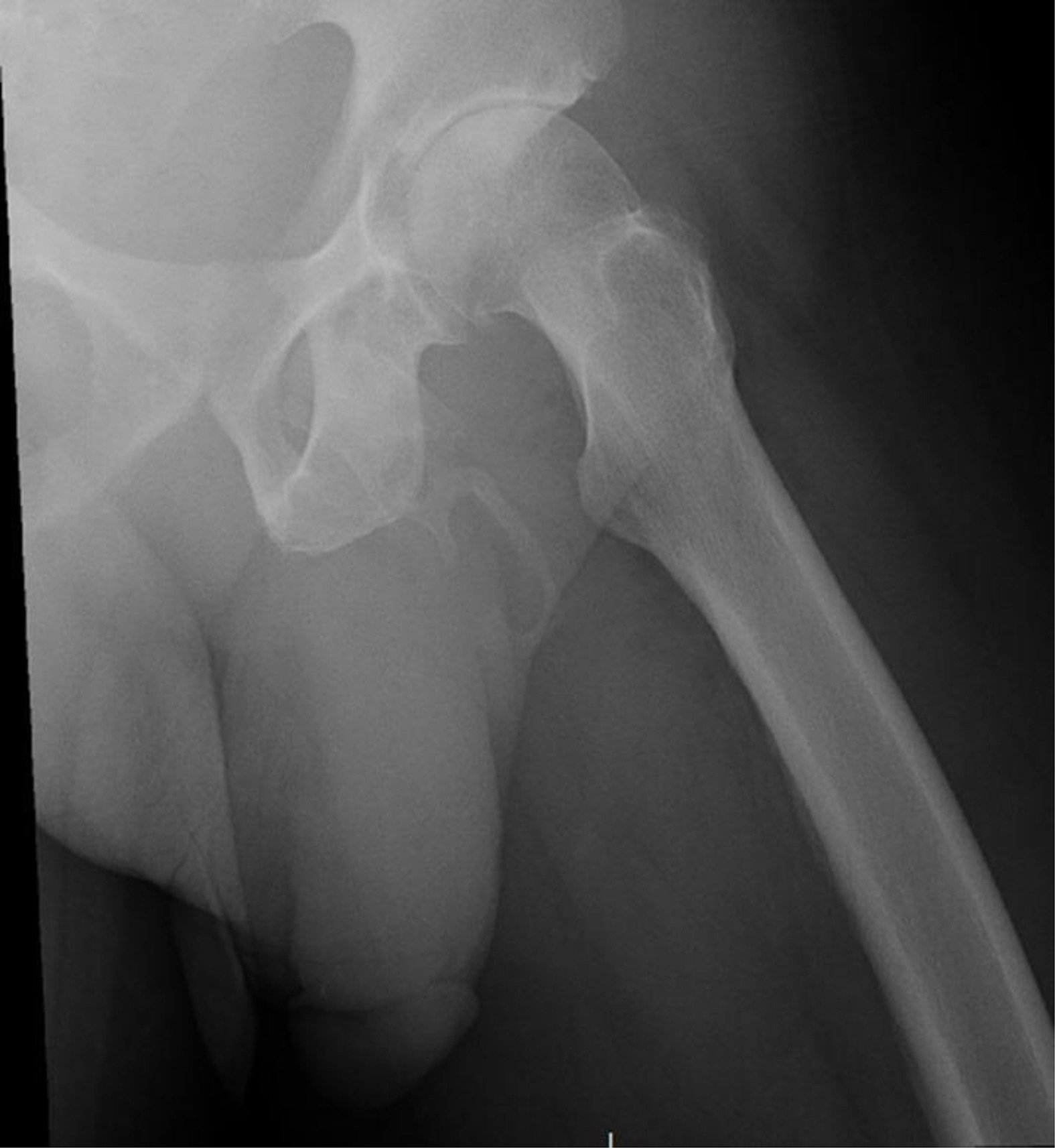 Doctors Take Hip X-Ray, Discover Patient's Penis Is Literally Turning ...