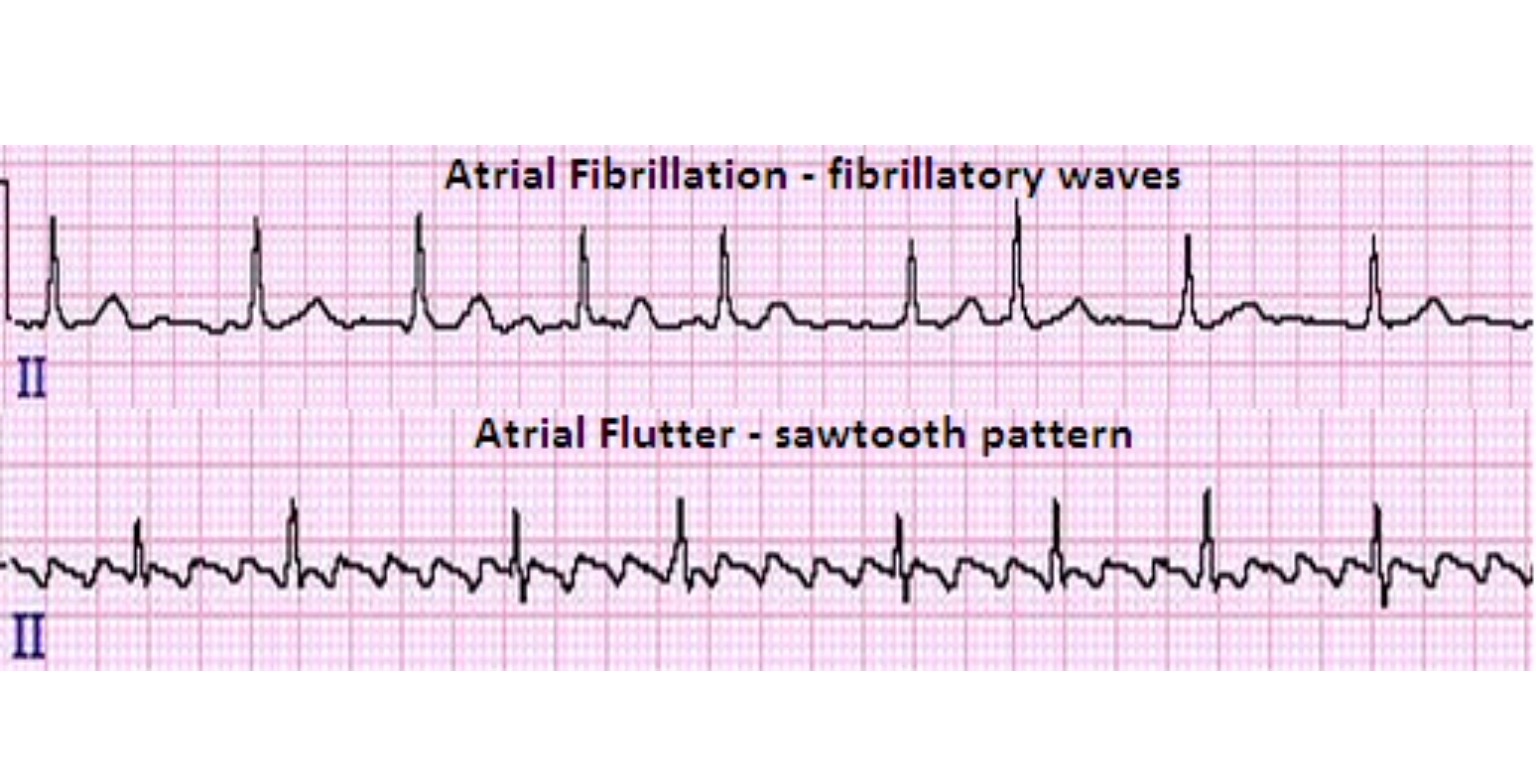 atrial flutter 2 to 1 vs 4 to 1