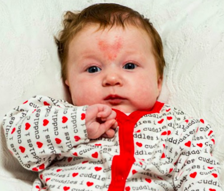 17 Rare Birthmarks That Have To Be Seen To Be Believed Faculty Of