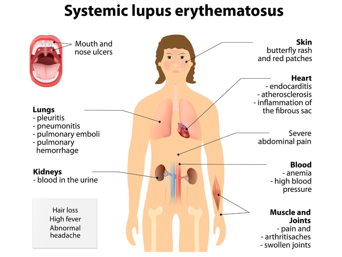 Lupus Facial Rash