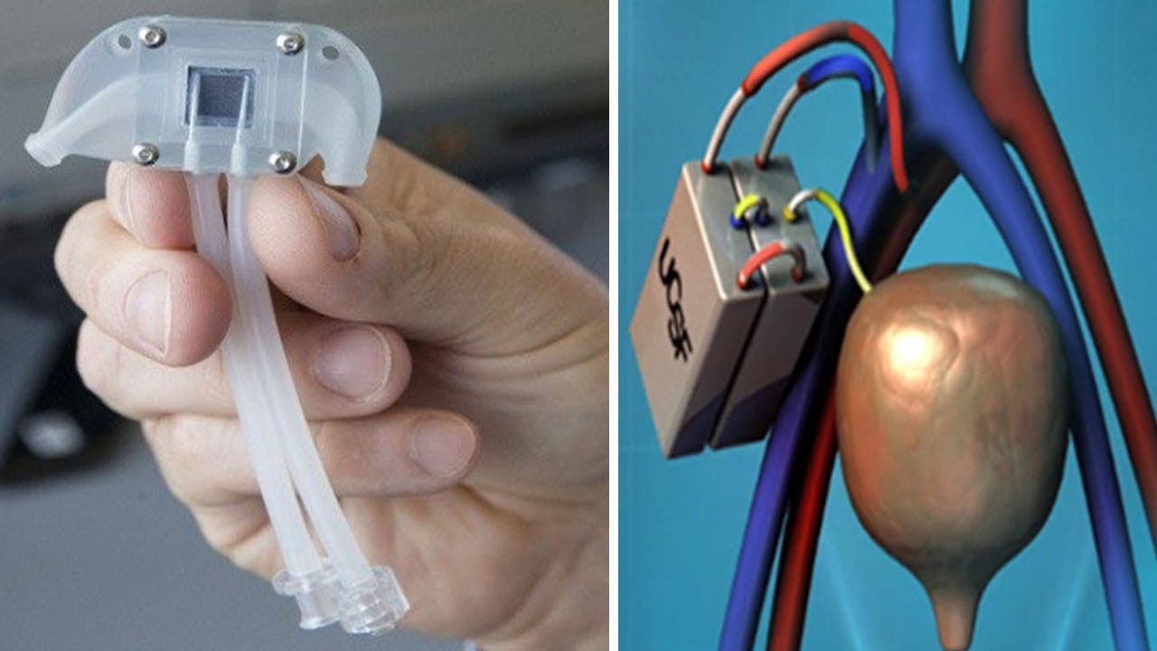 No more dialysis, Scientists Have Developed A Bionic Kidney!