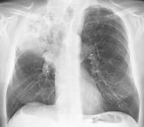 После поражение легких. Крупозная пневмония рентген снимок. Крупозная пневмония легкого рентгенограмма. Рентгенография крупозной пневмонии. Крупозная пневмония легкого рентген.