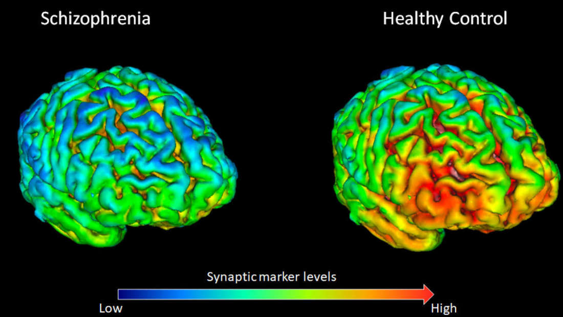 new research on schizophrenia suggests that