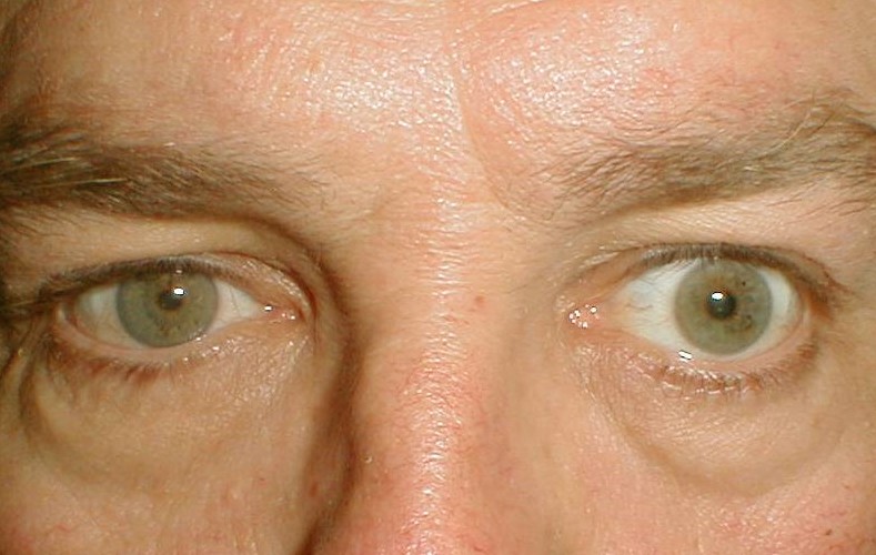 miotic pupil