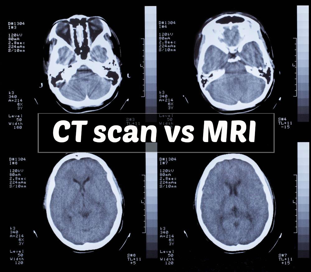 MRI Unlikely To Catch Speedy CT For Initial Stroke Imaging ...