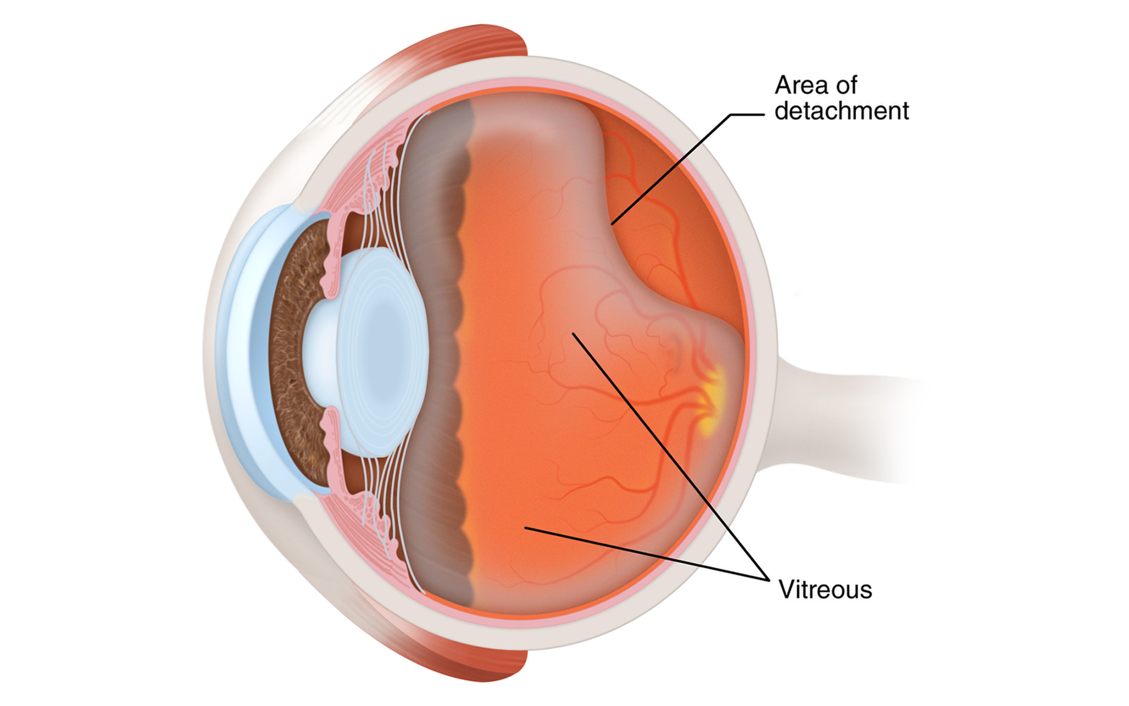 Прозрачное тело в глазу. Отслойка стекловидного тела. Задняя отслойка стекловидного тела глаза симптомы. Отслоение гиалоидной мембраны глаза. Задняя гиалоидная мембрана стекловидного тела.