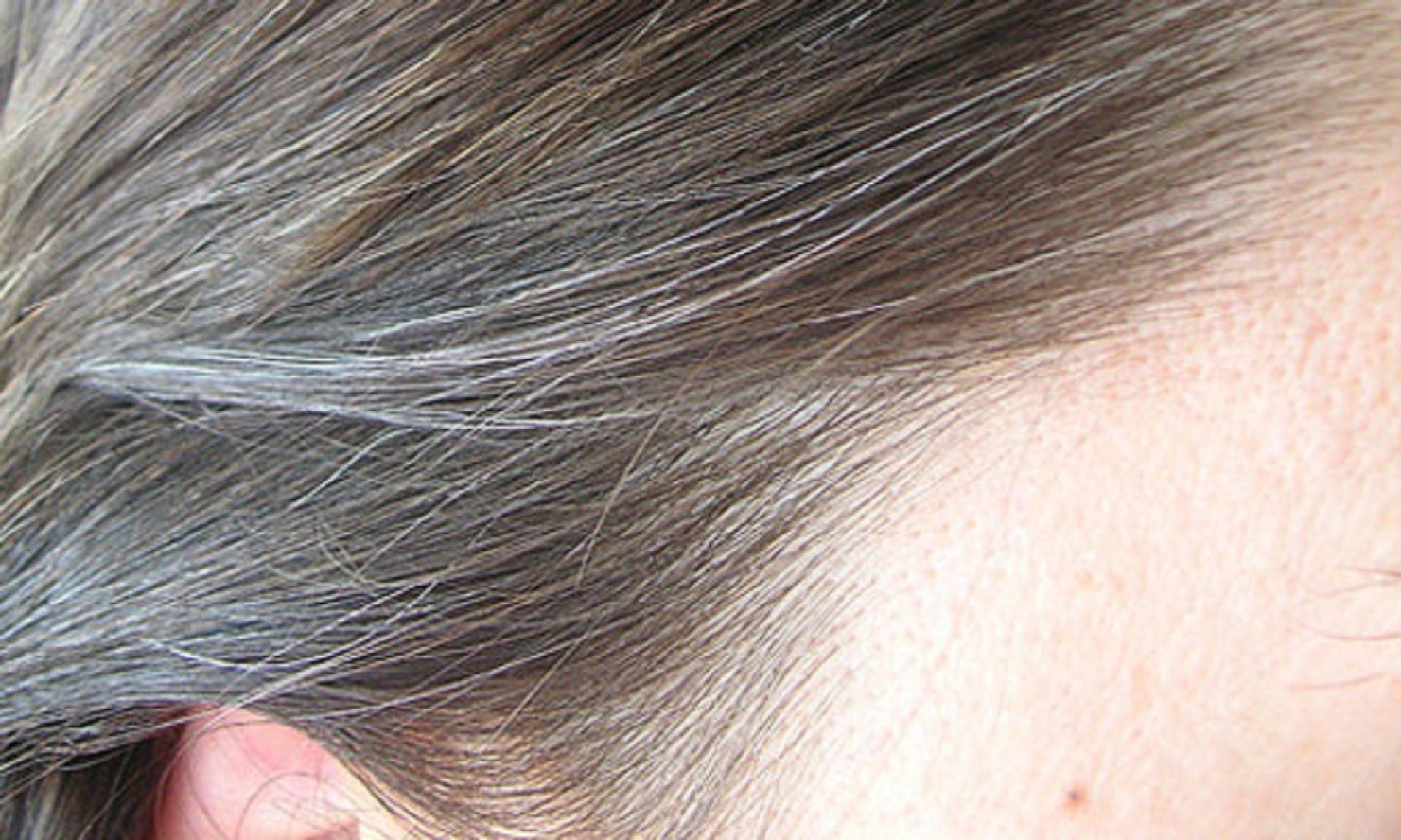 What Causes White Hair at a Young Age? | Faculty of Medicine
