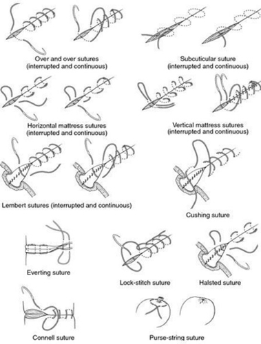 most common sutures types | Faculty of Medicine