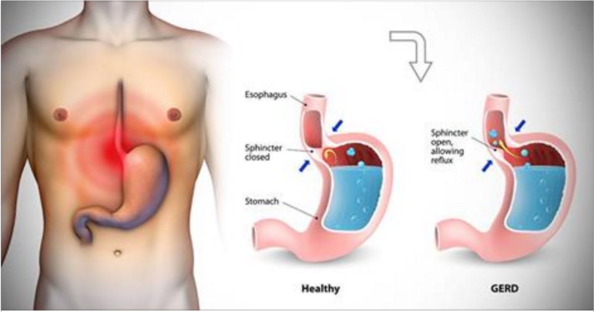 Gerd Pain Nusagates