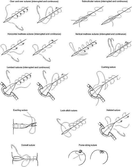 Purse-string suture using the novel endoloop and repositionable clips... |  Download Scientific Diagram