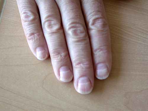 White spots on the nails of the male hand caused by a deficiency of  calcium, zinc or poisoning by household chemicals on a pink background.  This disease is called leukonychia. Stock Photo |