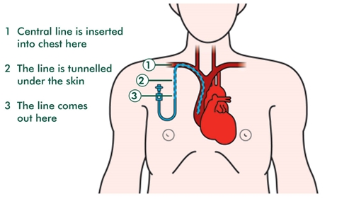 How to Insert a Central Line | Faculty of Medicine