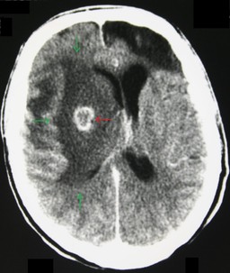 brain ct.jpg