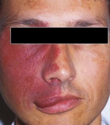 sturge weber syndrome.jpg