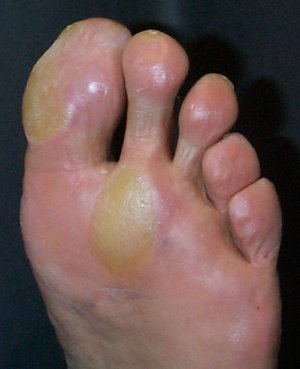 Foot Disease.jpg