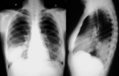 Chest Xray.jpg