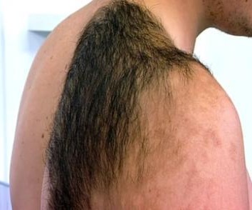 Becker Nevus.jpg