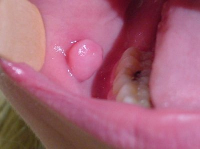 oral_fibroma_082001.JPG