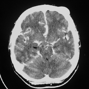 Frontal_Bone_Osteoma_CT_Scan_Axial_300_SQ.jpg