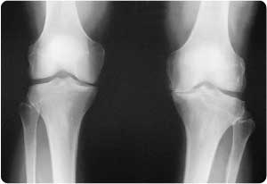 knee-osteoarthritis-x-ray.jpg