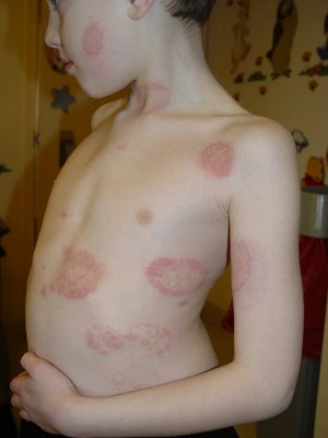 tinea_corporis_2_040214.jpg