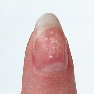 white-spots-fingernails.jpg