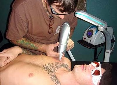 laser-tattoo-removal.JPG