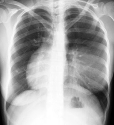 Chest Xray.jpg