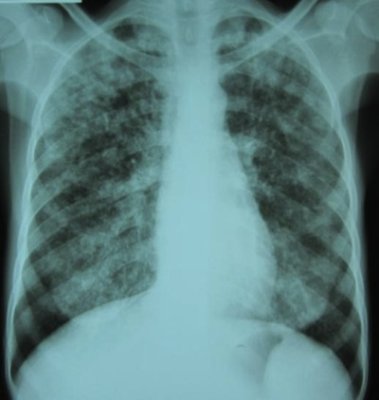 Chest Xray.jpg