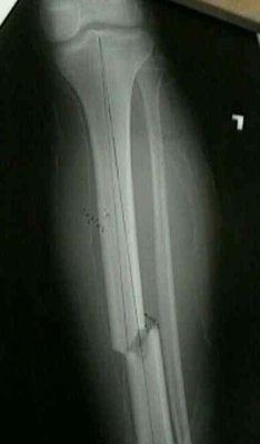 Leg Xray.jpg